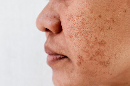 Dark Spots