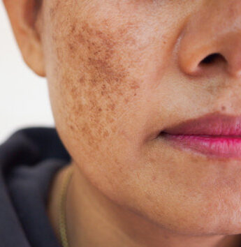 Pigmentation